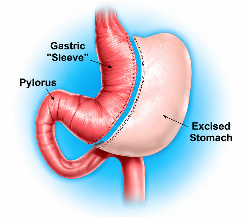 Sleeve Gastrectomy