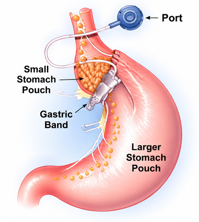 Gastric Banding